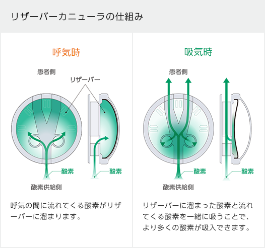 リザーバーカニューラの仕組み